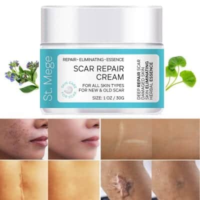 St.Mege Scar Removal Cream for Men and Women